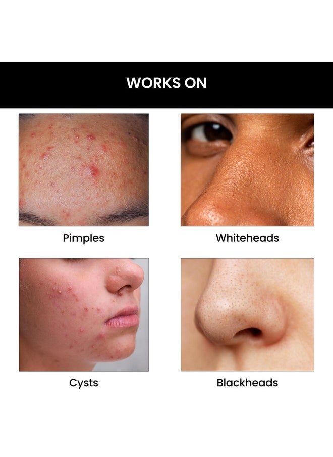 Goodbye Acne™ Face Wash | Reduces Acne-Causing Bacteria & Sebum Production | Men & Women, 100Ml