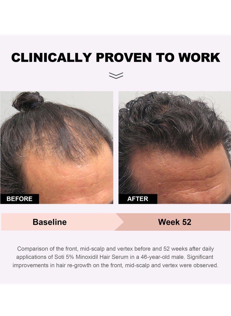 Minoxidil 5% Hair Growth, Hair Loss Regrowth Serum 60ml. Made in USA! Dermatologists Recommended. Ginseng and Biotin Extra Strength Formula (3 Pack)