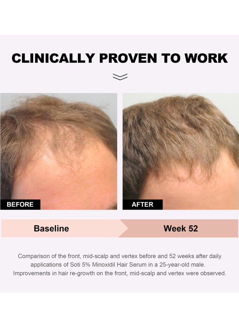 Minoxidil 5% Hair Growth, Hair Loss Regrowth Serum 60ml. Made in USA! Dermatologists Recommended. Ginseng and Biotin Extra Strength Formula (3 Pack)