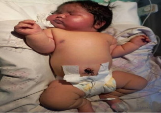 تولد نوزاد 6 کیلویی در مشهد