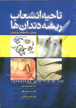 ناحیه انشعاب ریشه دندان ها: بیماری، تشخیص و درمان